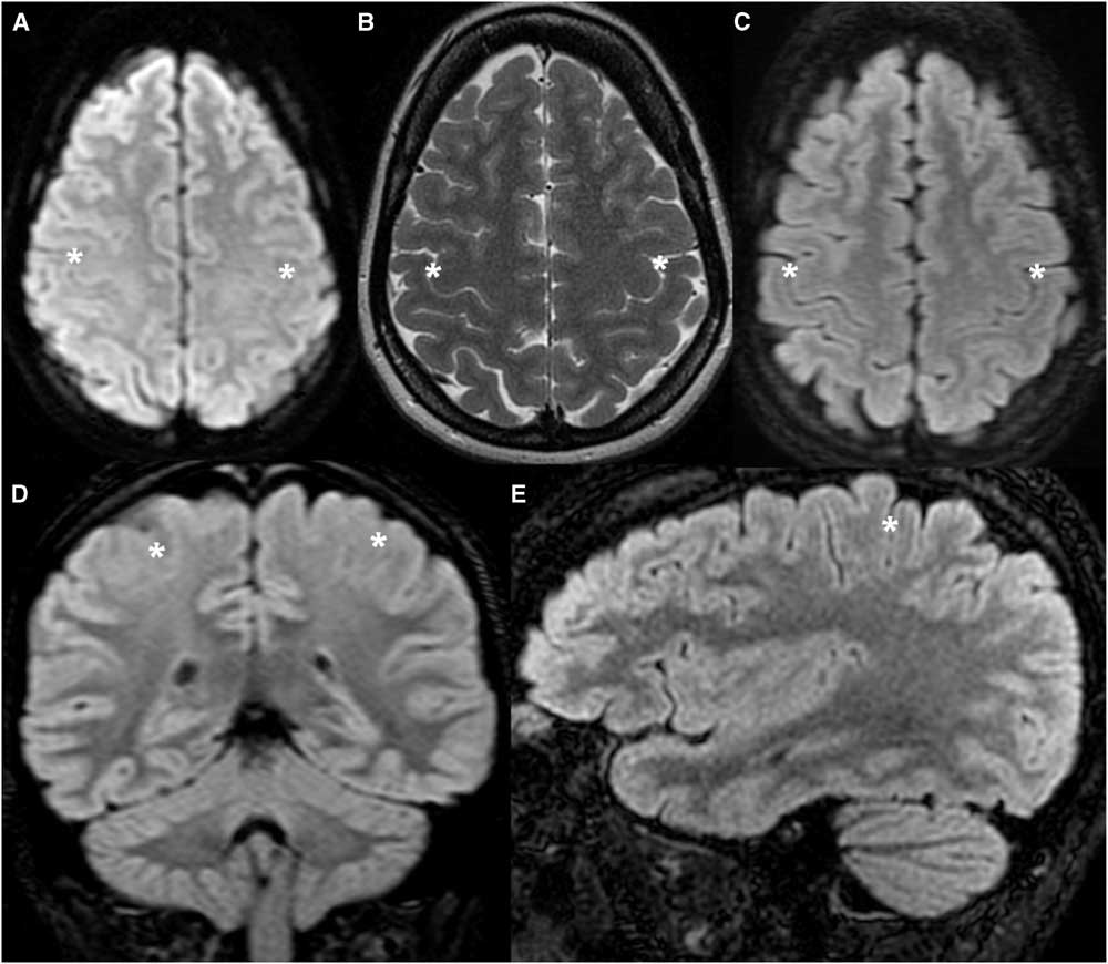 The Uniform Cortex Sign: A Diagnostic Sign of Diffuse Cortical Injury ...