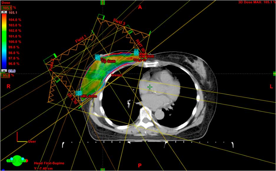 Dosimetric Study Of Three Dimensional Conformal Radiotherapy Electronic Compensator Technique Intensity Modulated Radiation Therapy And Volumetric Modulated Arc Therapy In Whole Breast Irradiation Journal Of Radiotherapy In Practice Cambridge Core