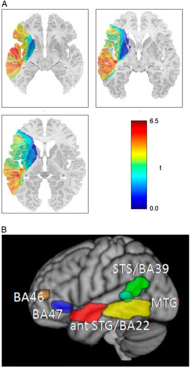 What Do Language Disorders Reveal About Brainlanguage - 