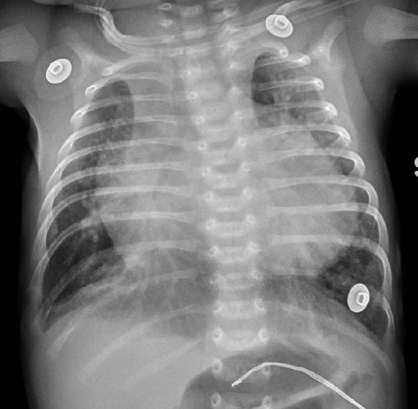 Breathing Complaints Chapter 3 Pediatric Emergency Medicine