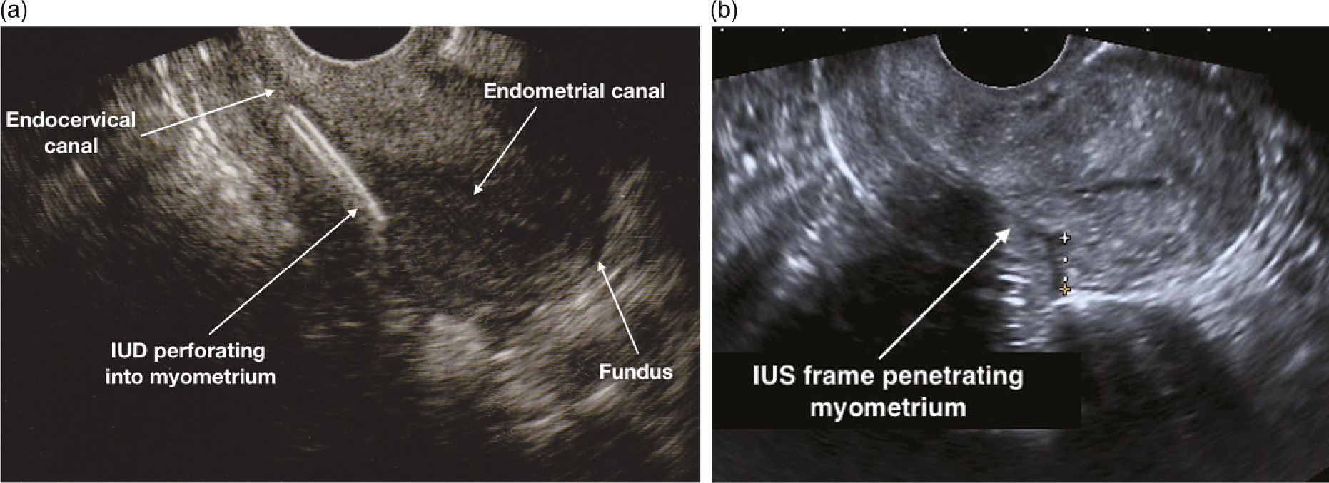 Ultrasound Imaging In Relation To Intrauterine, 59% OFF