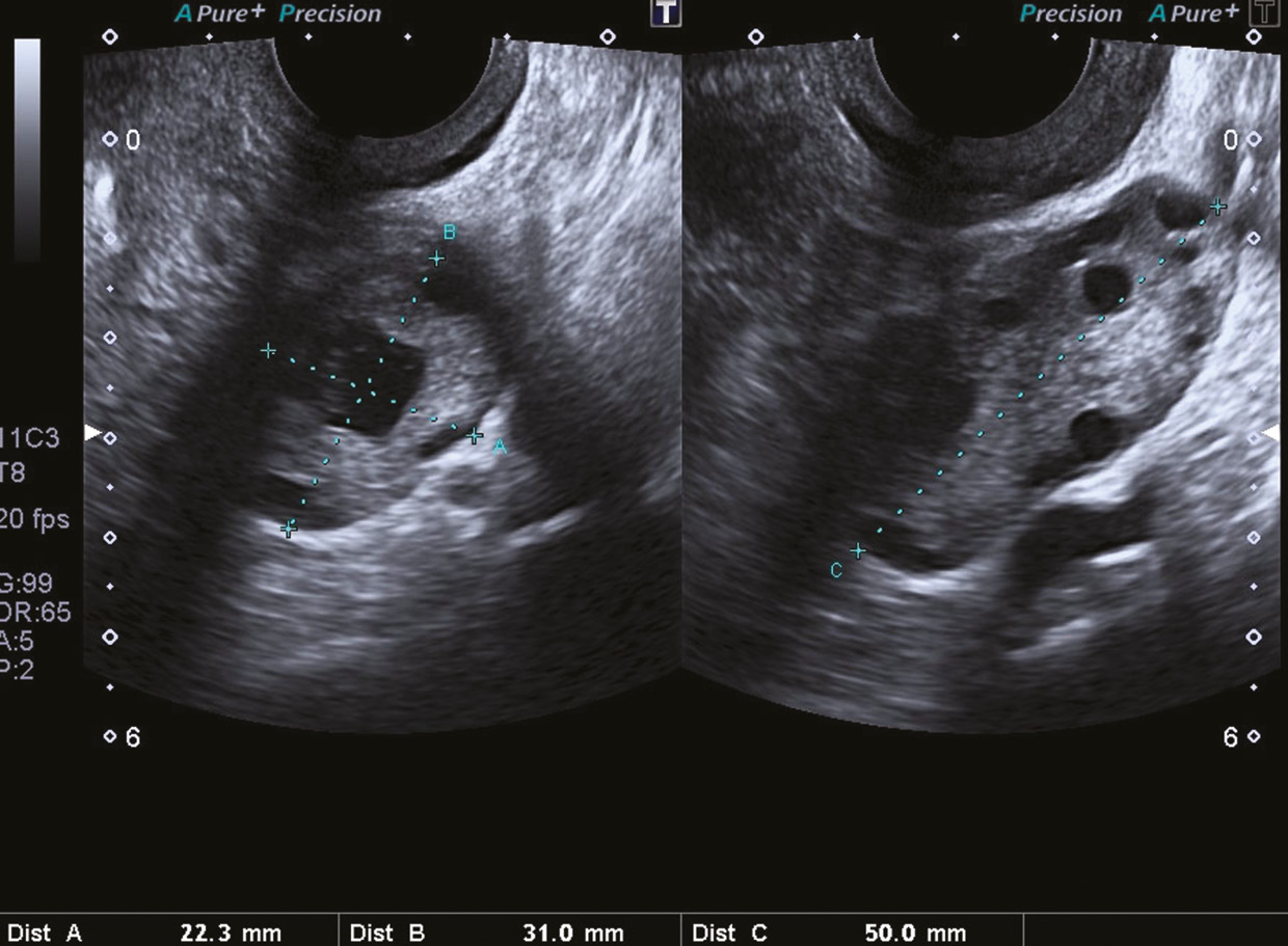 Baseline transvaginal ultrasound scan in patient 1 showing an AFC of 60