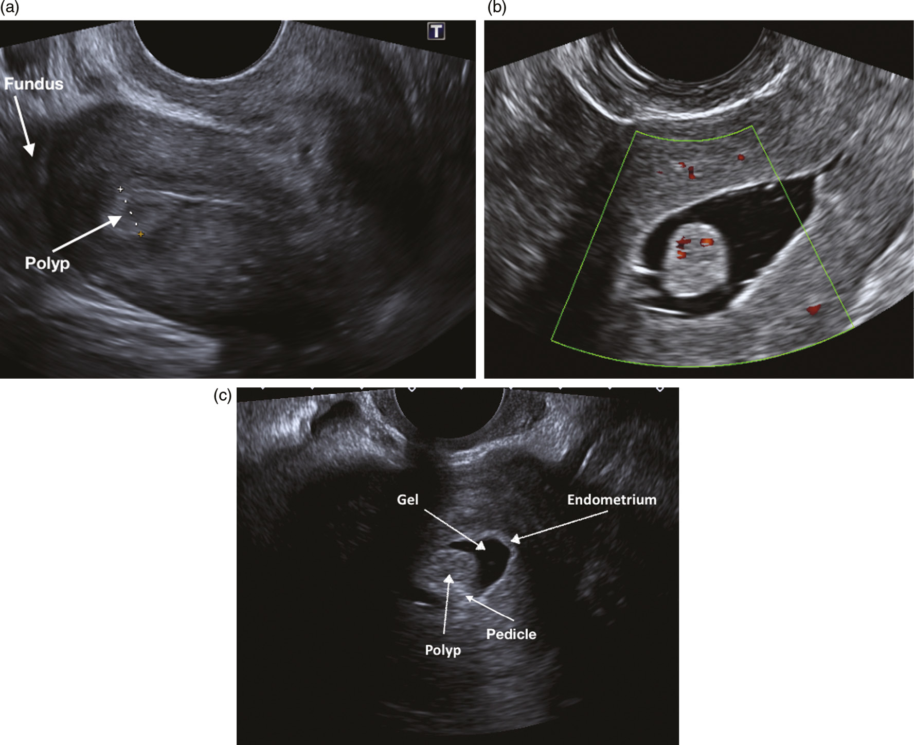 abnormal transvaginal ultrasound