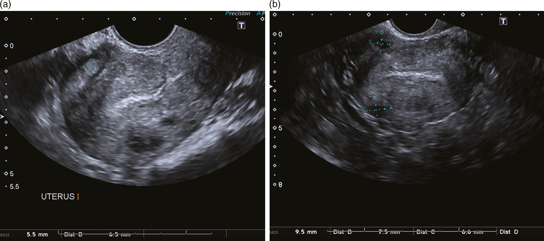 Ultrasound Imaging Of Women With Abnormal Uterine Bleeding Aub Chapter 13 Ultrasound In Reproductive Healthcare Practice