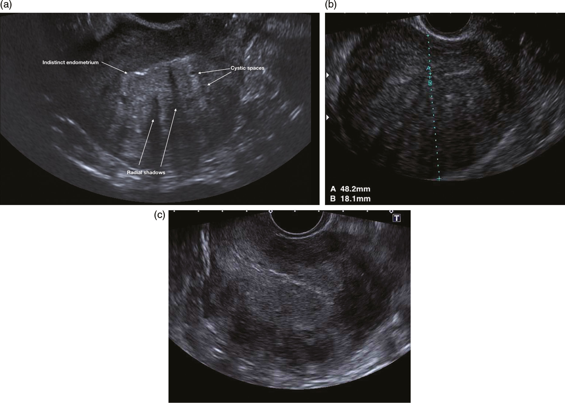 Ultrasound Imaging Of Women With Abnormal Uterine Bleeding Aub Chapter 13 Ultrasound In Reproductive Healthcare Practice