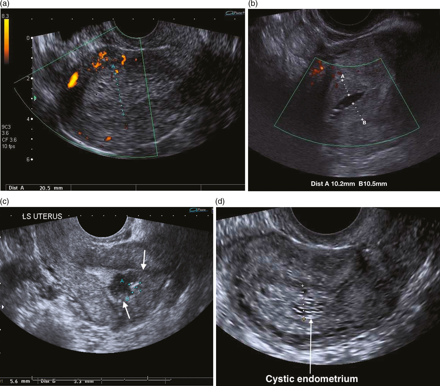 abnormal transvaginal ultrasound