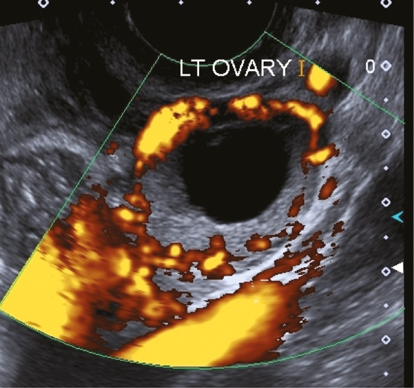 Ectopic Pregnancy – The Tubal Ring Sign, Ring of Fire, and  Pseudogestational Sac – RADIOLOGYPICS.COM