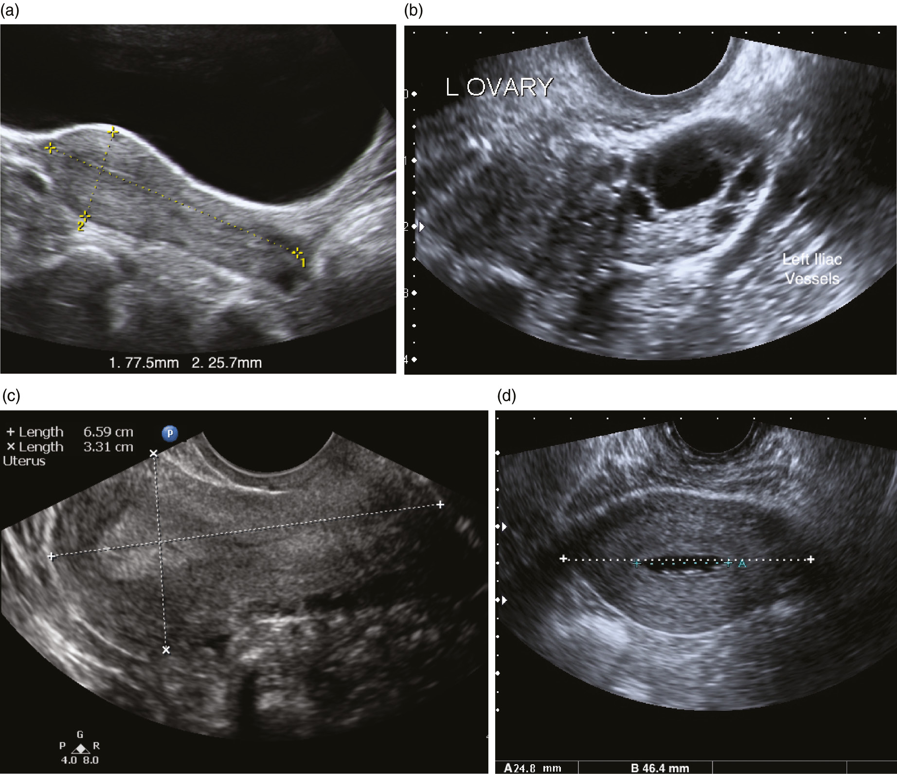 Ultrasound Of Pelvic Anatomy Scanning Techniques And Normal Findings Chapter 4 Ultrasound In Reproductive Healthcare Practice