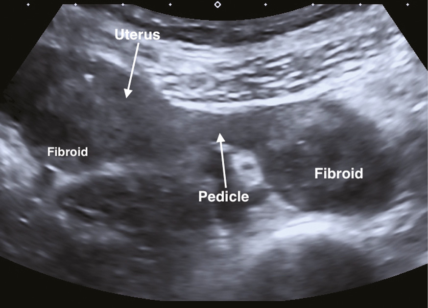 abnormal transvaginal ultrasound