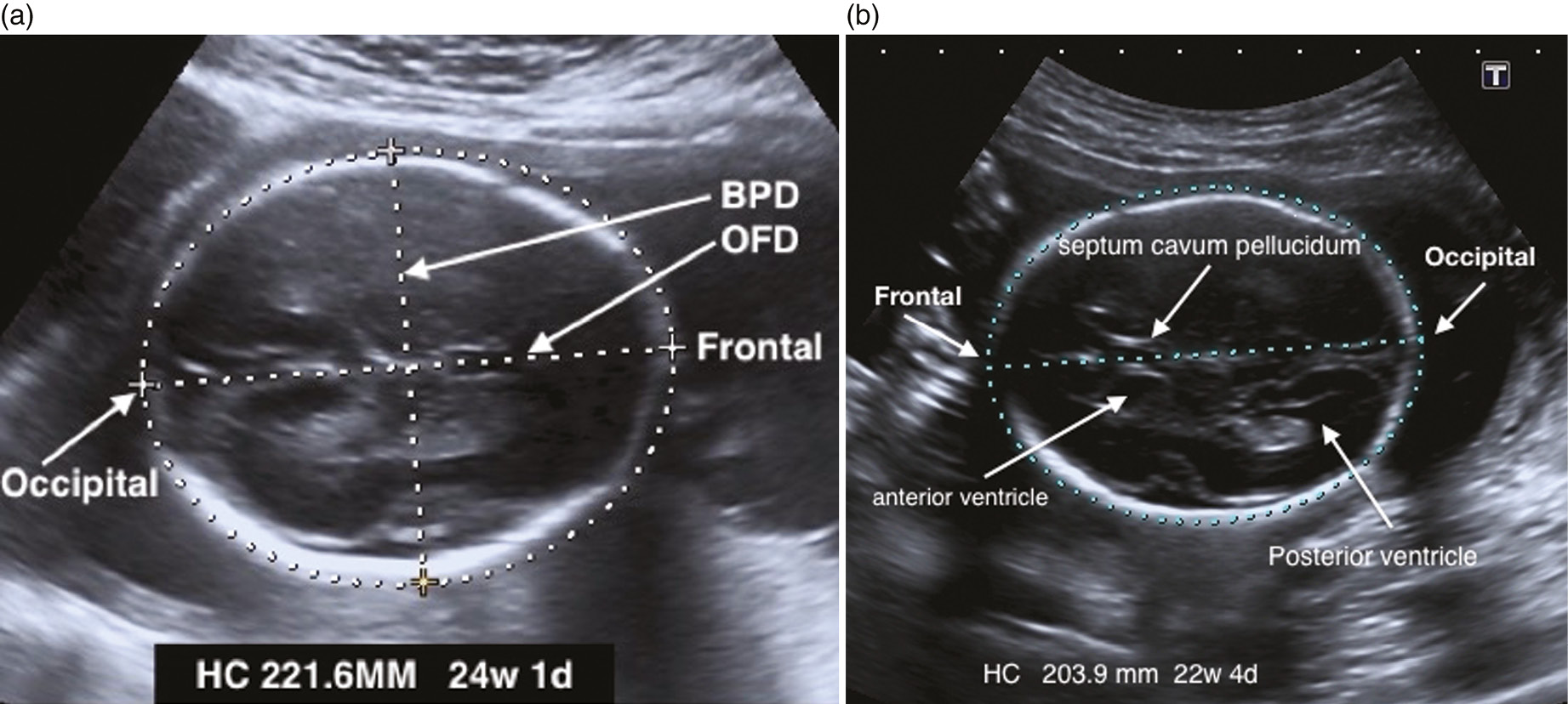 Dating criteria ultrasound First trimester