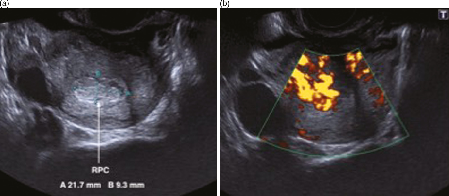 Pregnancy Ultrasound For Srh Work Chapter 7 Ultrasound In Reproductive Healthcare Practice