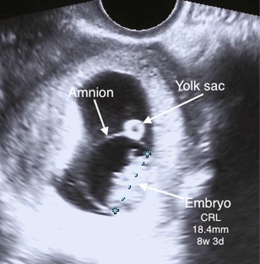 Amnion Ultrasound