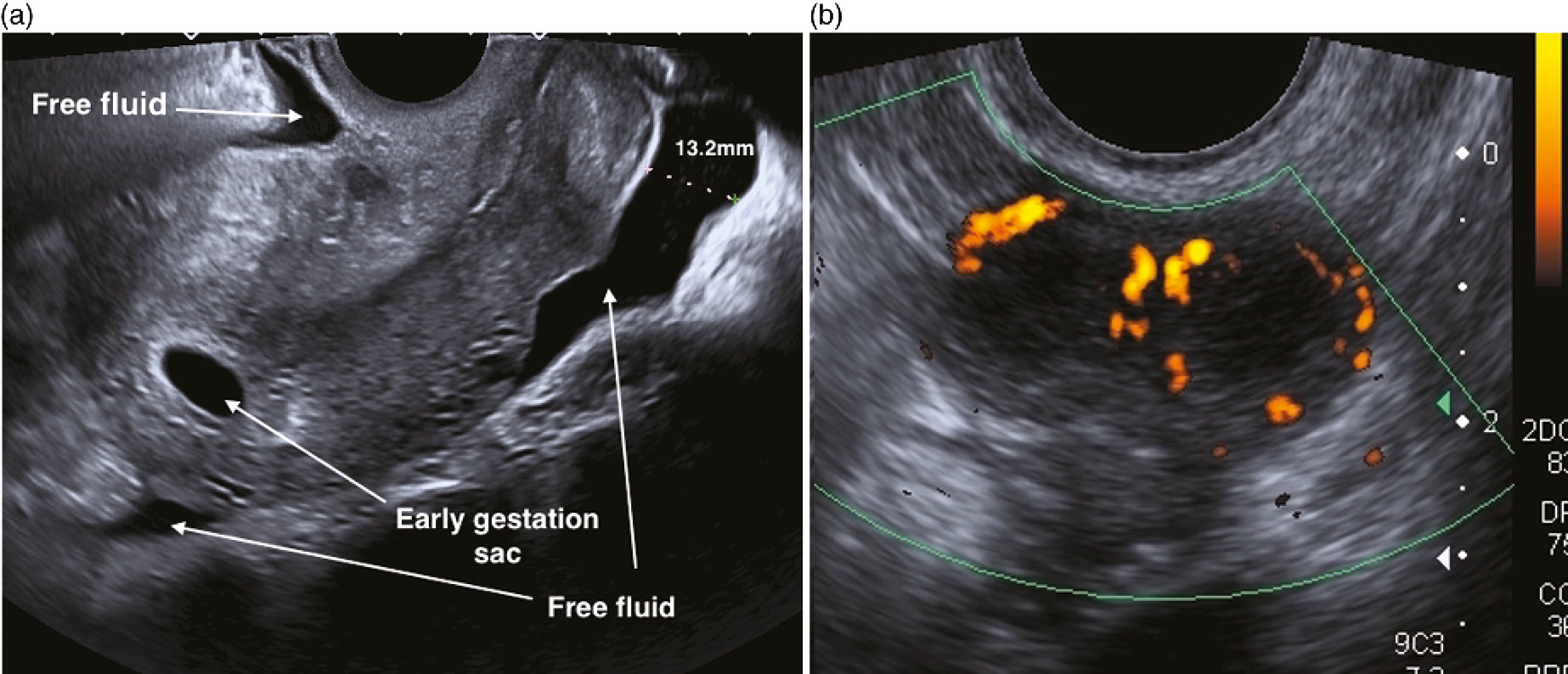 Laparoscopic management of ruptured heterotopic pregnancy after  intrauterine insemination | CMAJ