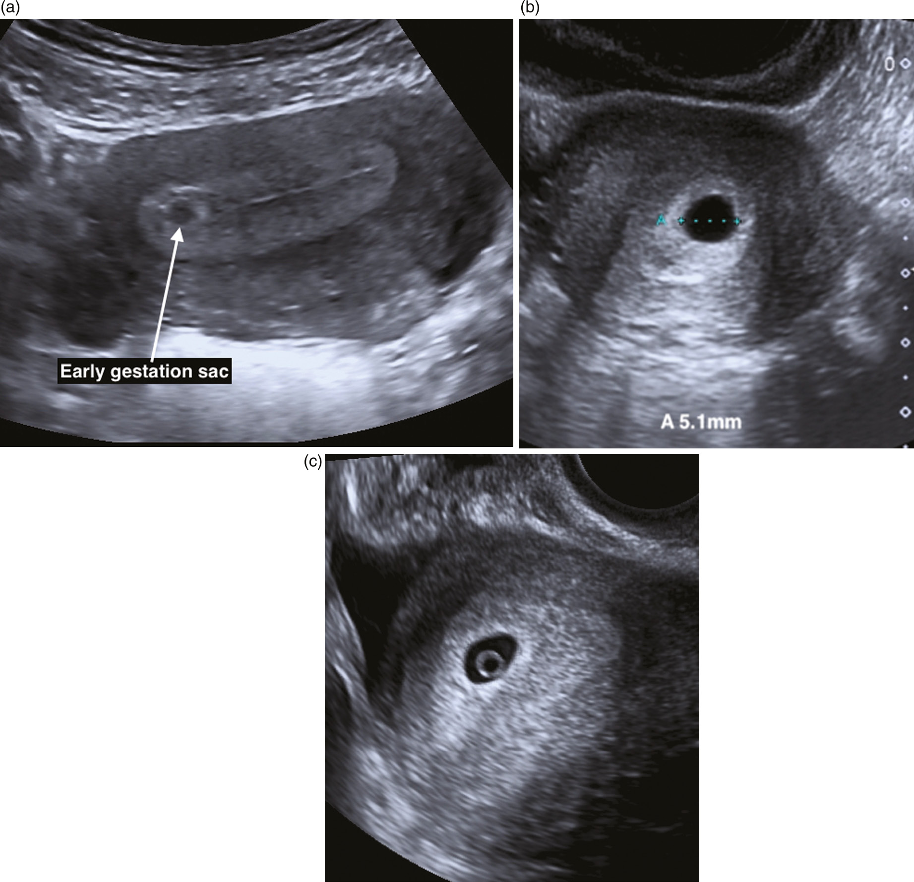 Ectopic Pregnancy Ultrasound