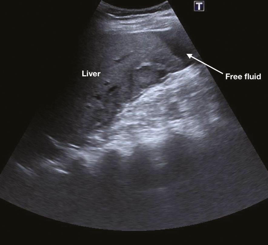 Ultrasound Assessment Of A Potential Ectopic Pregnancy Chapter 8 Ultrasound In Reproductive Healthcare Practice