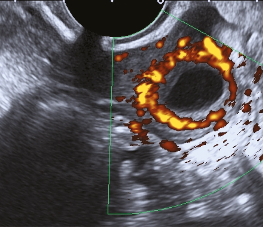 How Frequently Benign Uterine Myomas Appear Suspicious for Sarcoma as  Assessed by Transvaginal Ultrasound?