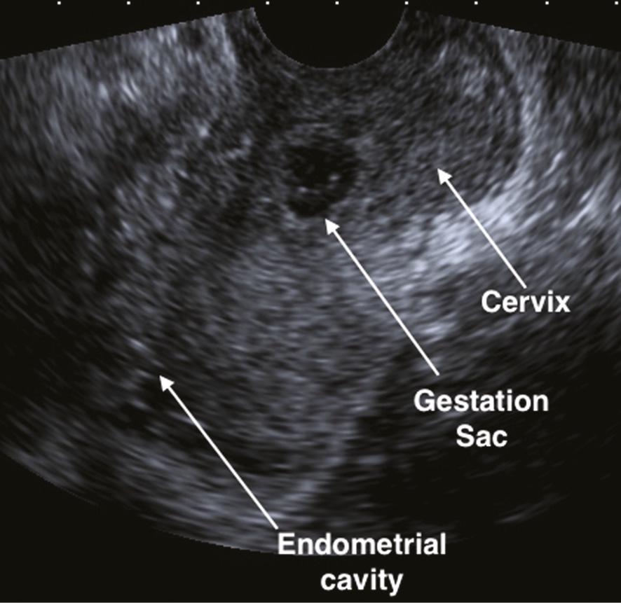 cervical ectopic pregnancy
