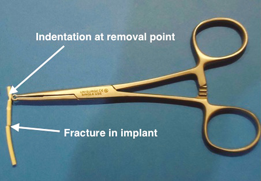 Difficult removal of subdermal contraceptive implants: a