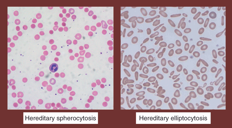 elliptocytes