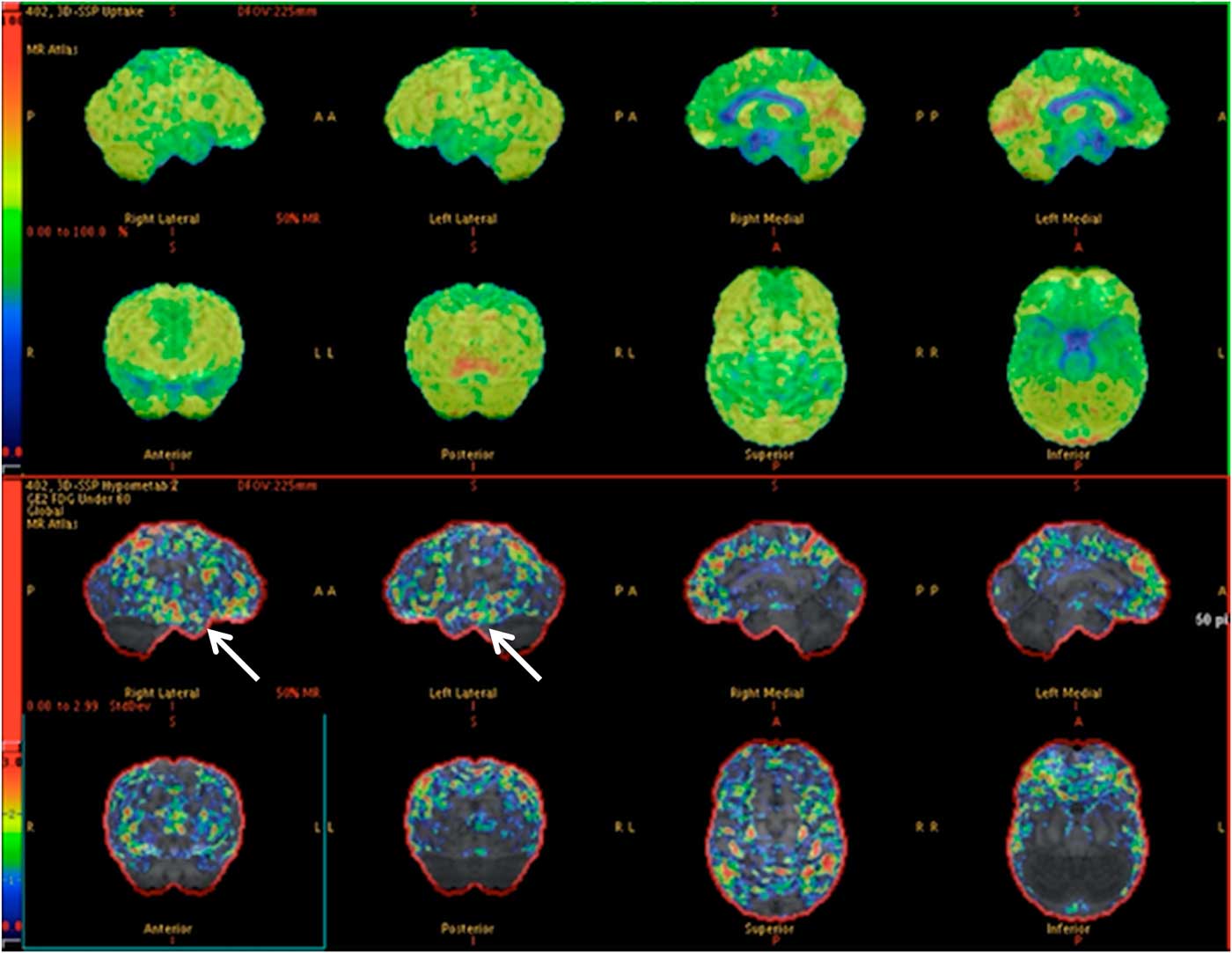 Refractory Epilepsy: The Role of Positron Emission Tomography ...