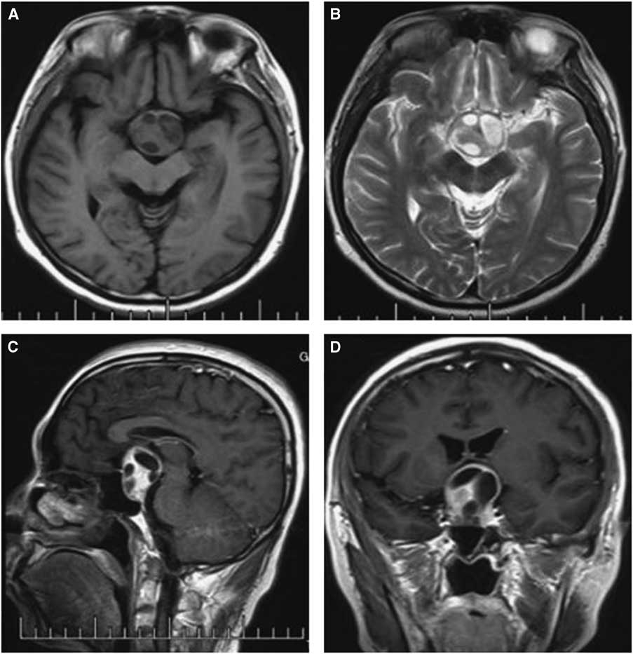 Pituitary Adenoma Associated With Rathkes Cleft Cyst Report Of 15 Cases Canadian Journal Of 2330