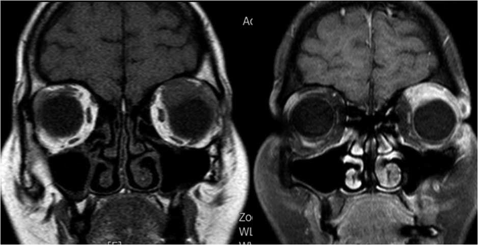 Orbital Myositis: An Underrecognized Clinical Syndrome With A Need Of ...