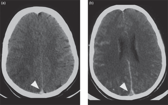 Cerebral Venous Sinus Thrombosis Chapter 8 Emergency Cross Sectional Radiology