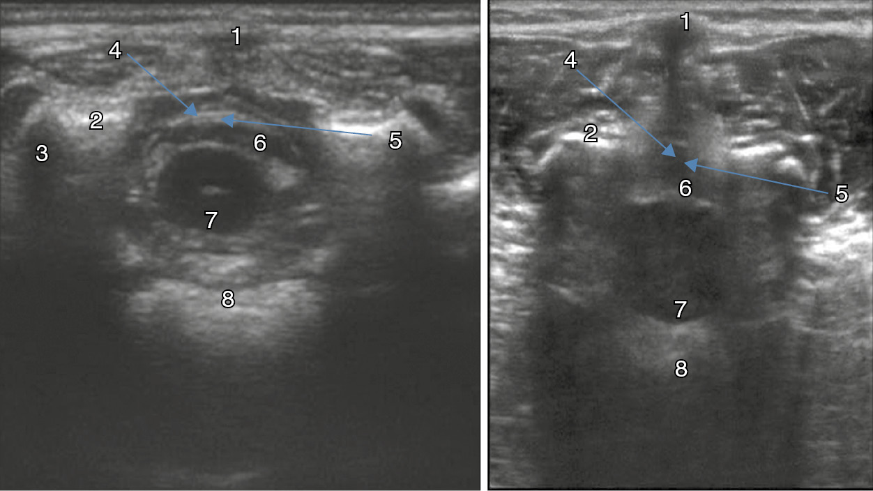 Analgesia for iliac crest bone graft (Chapter 34) - Decision-Making in  Orthopedic and Regional Anesthesiology