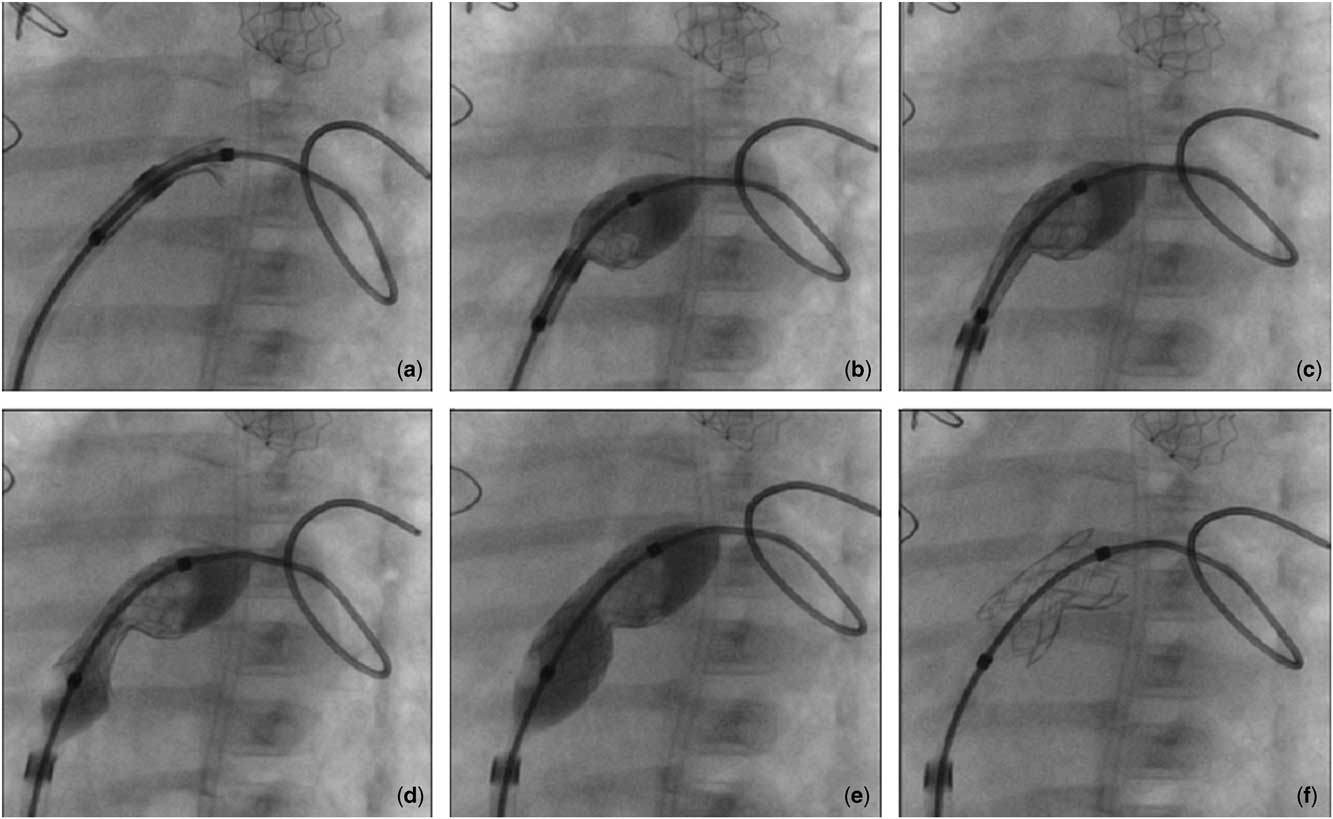 Atrial septal defect morphology and stenting in hypoplastic left heart ...