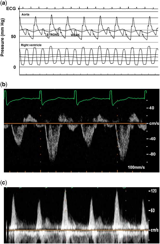 alternans