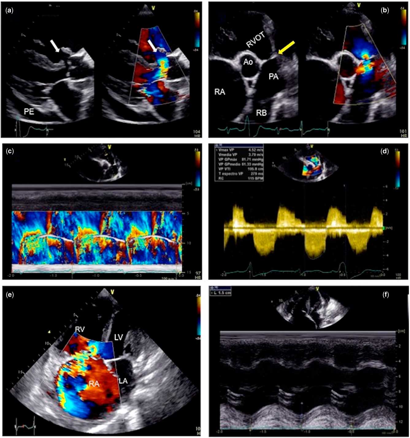 Ascites in an uncorrected tetralogy of Fallot with pulmonary valve ...