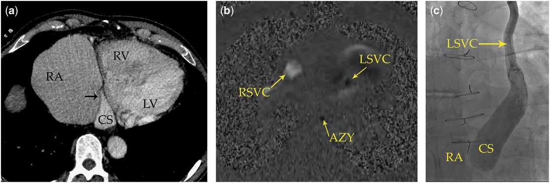 Coronary sinus ostial atresia with persistent left superior caval vein ...