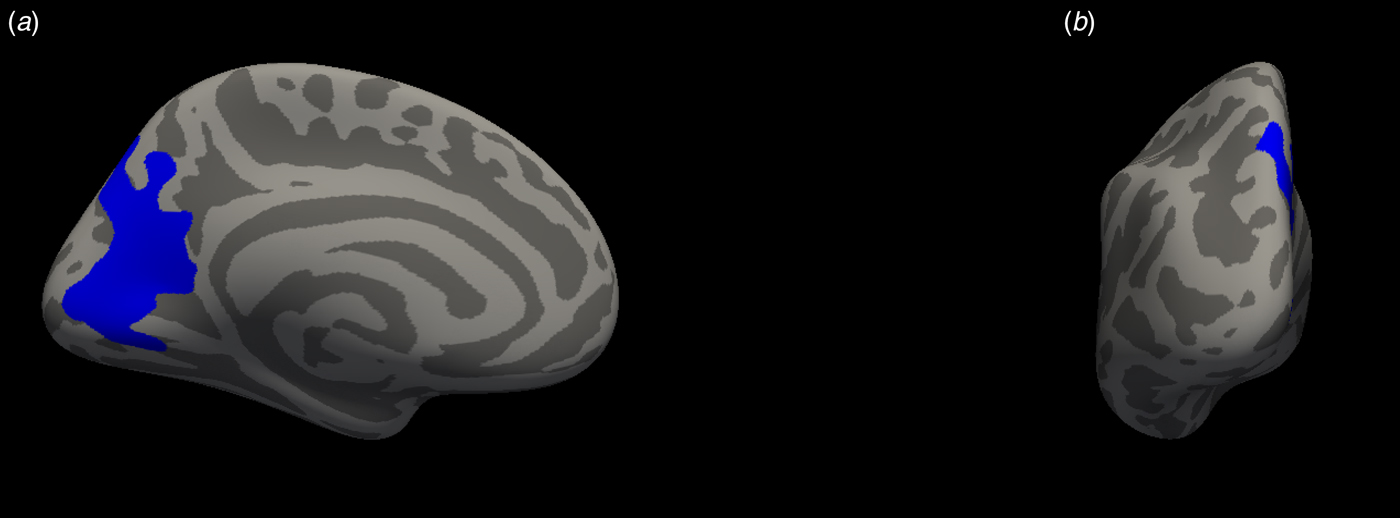 Grey matter volume and thickness abnormalities in young people with a ...