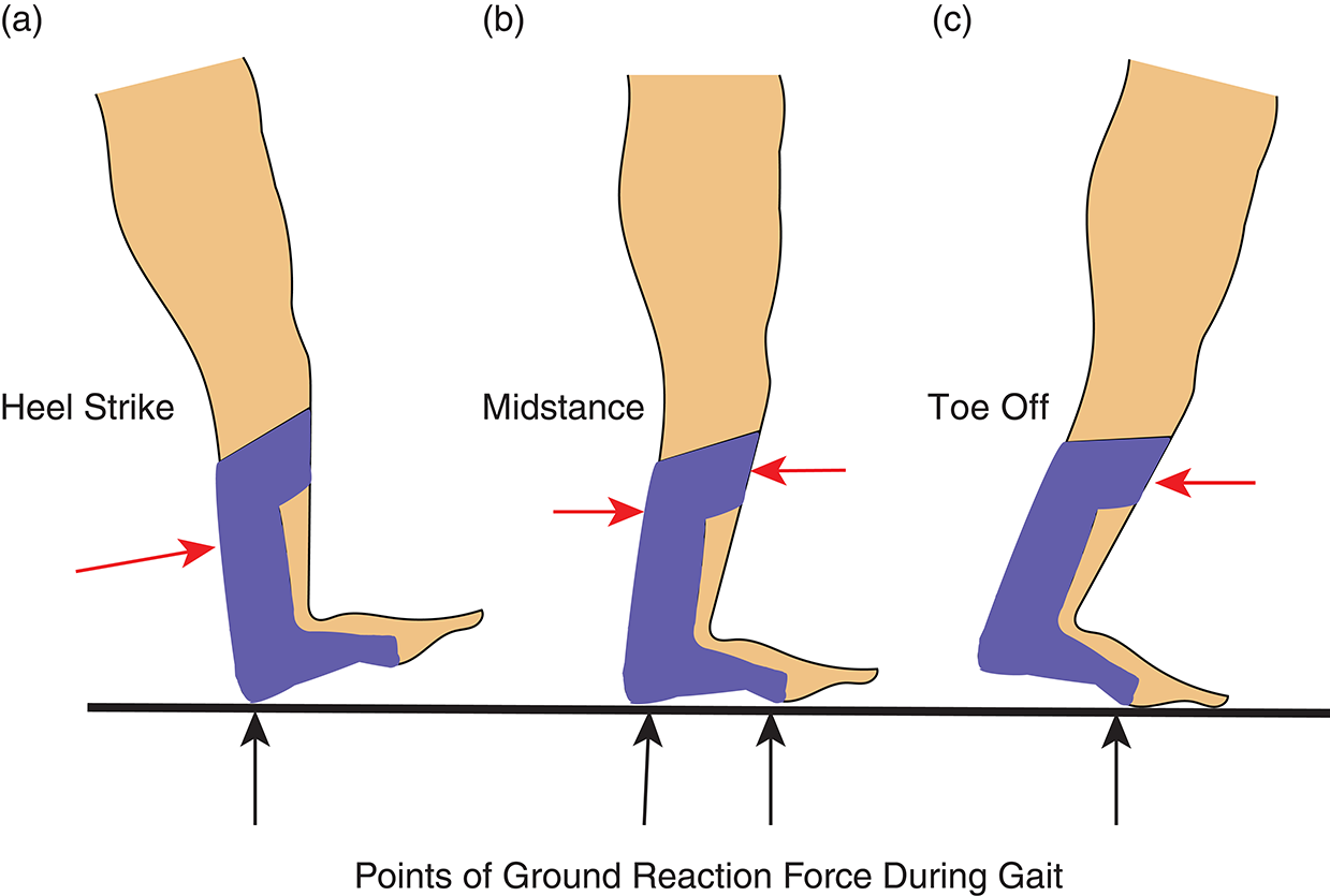 A) Plantar-flexion Stop AFO, (b) Hinged AFO, (c), Plantar Flexion ...