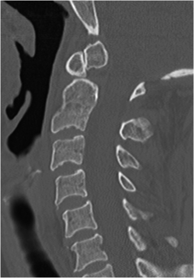 Os Odontoideum (Case 5) - Clinical Imaging of Spinal Trauma, image size:822x1175