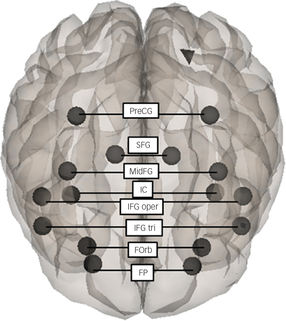 Interhemispheric Functional Disconnection Because Of Abnormal Corpus Callosum Integrity In Bipolar Disorder Type Ii Bjpsych Open Cambridge Core