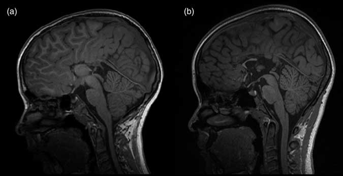 A Neuropsychological Profile For Agenesis Of The Corpus - 