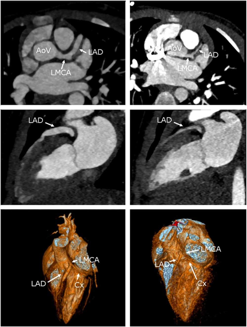 Usefulness and safety of anakinra in refractory Kawasaki disease ...