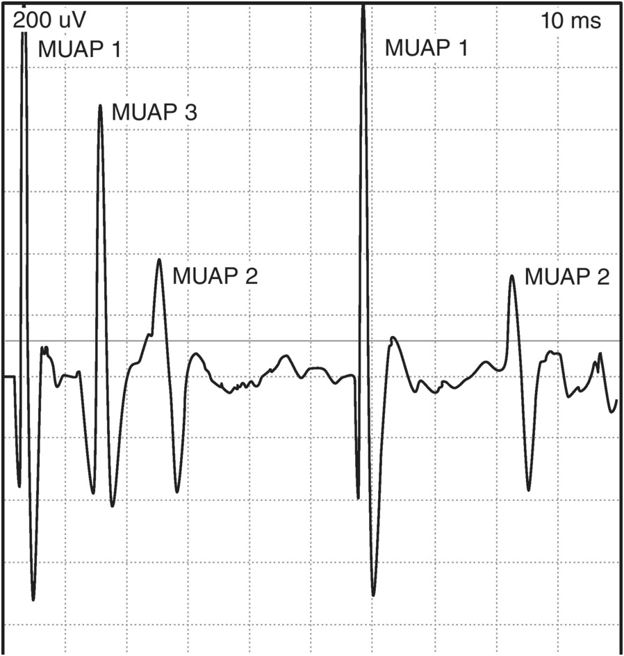 The Needle EMG Examination (Chapter 13) - Comprehensive 