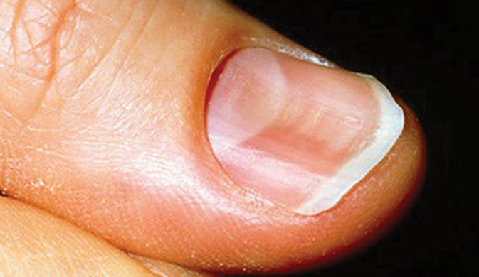Surprising Signs of Iron Deficiency in Your Skin, Hair & Nails