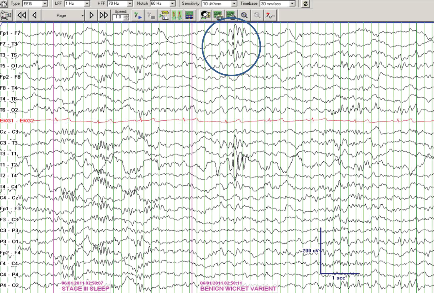 Abnormal Eeg Results Naxrewall