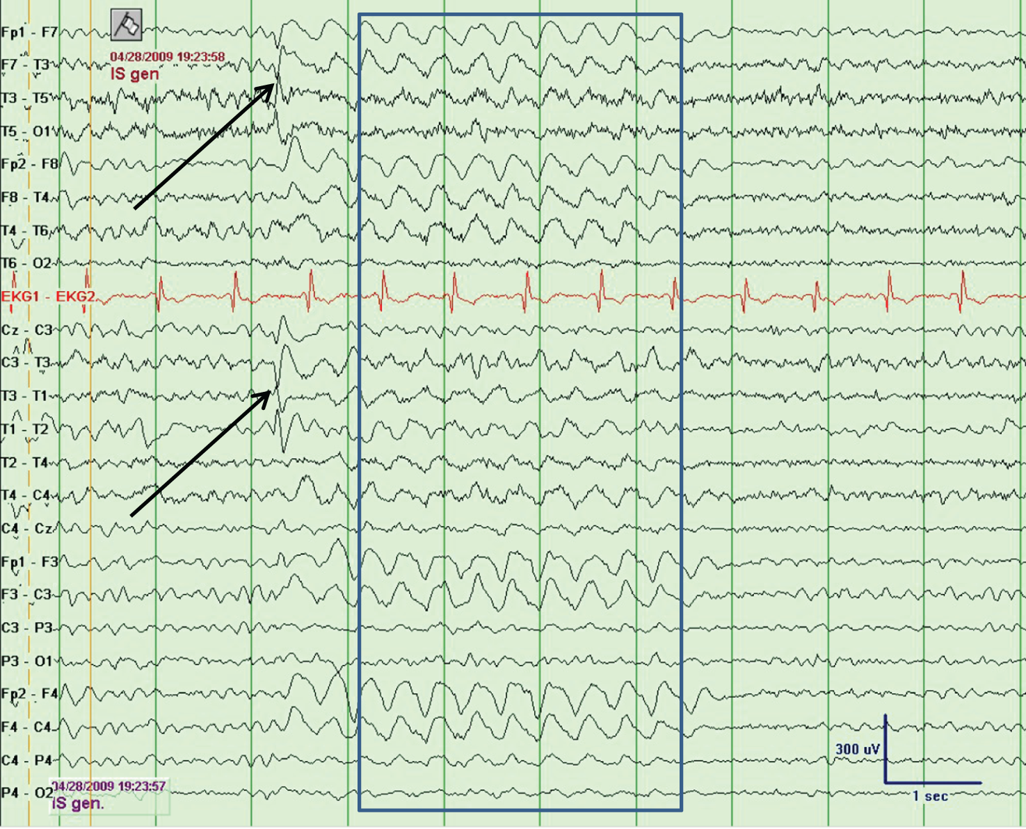 Mistaking Eeg Changes For Epilepsy Chapter 2 Common