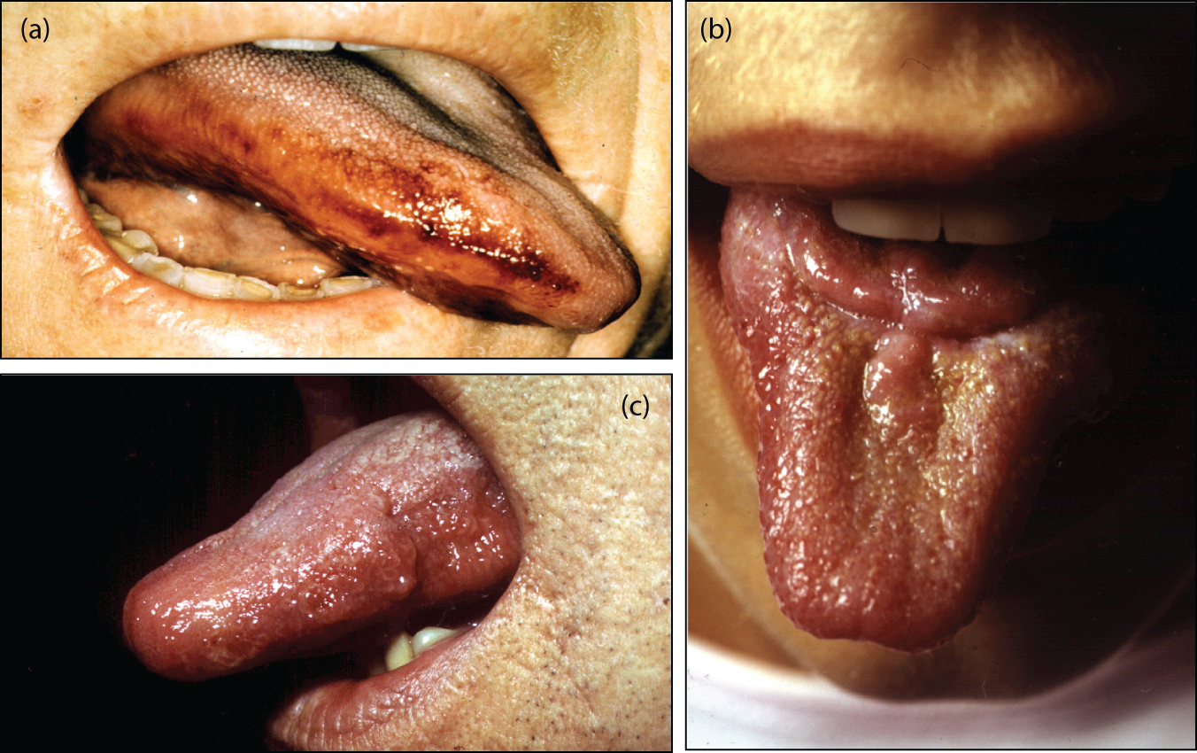 Errors in the Diagnosis of Seizure Types and Epilepsy Syndromes (Chapter 5)  - Common Pitfalls in Epilepsy