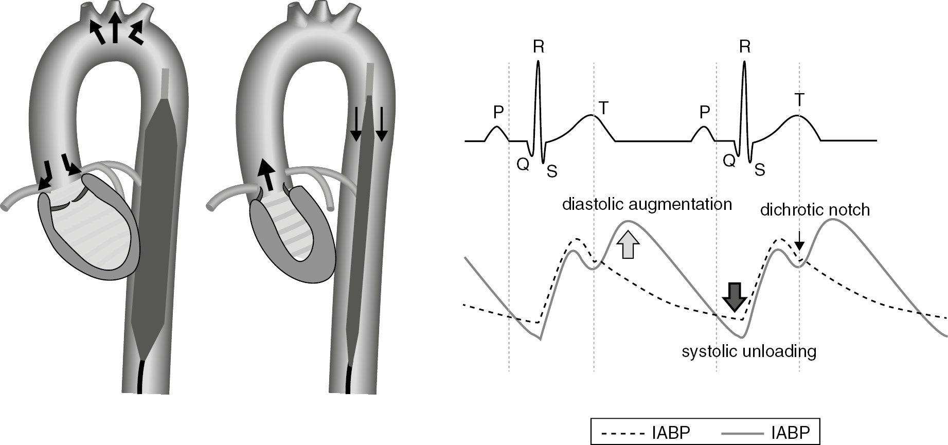 Percutaneous Mechanical Circulatory Support (Chapter 21) - Core 