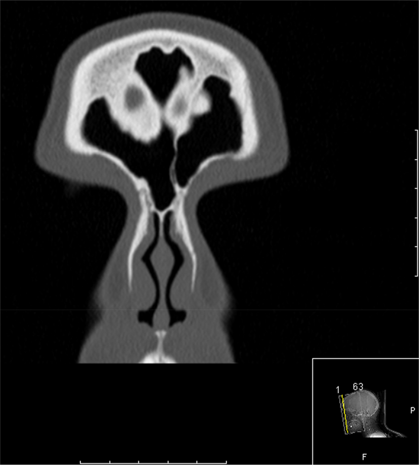 Fronto-septal rostrum: prevalence, classification and clinical ...