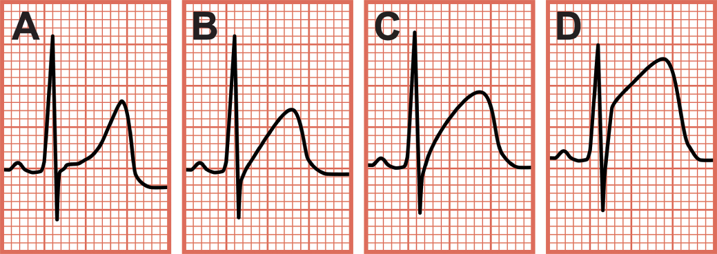 Inferior Wall Myocardial Infarction Chapter 2 Critical Cases In Electrocardiography