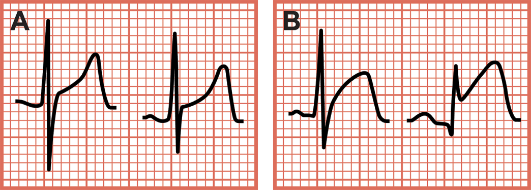 Confusing Conditions St Segment Elevations And Tall T Waves Coronary Mimics Chapter 7 Critical Cases In Electrocardiography