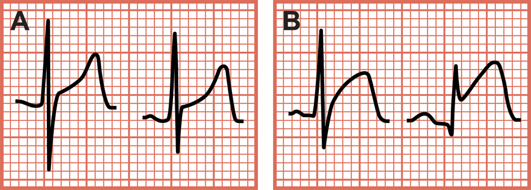 Confusing Conditions St Segment Elevations And Tall T Waves Coronary Mimics Chapter 7 Critical Cases In Electrocardiography Confusing Conditions St Segment Elevations And Tall T Waves Coronary Mimics Chapter 7 Critical Cases In Electrocardiography