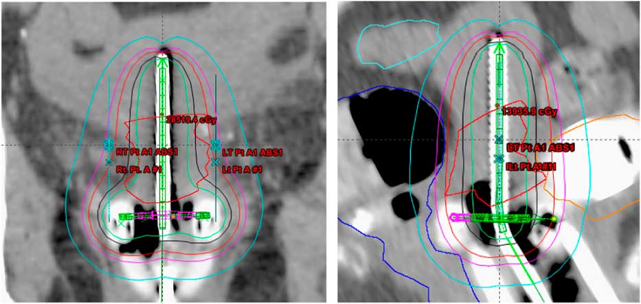 Dosimetric Evaluation Of Tandem Based Cervical High Dose Rate