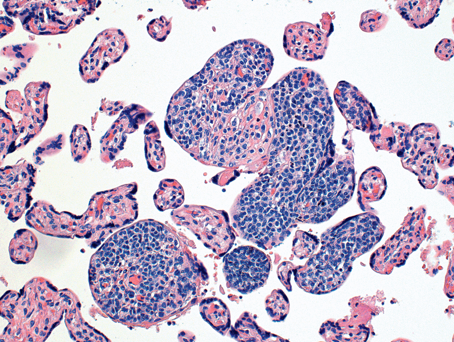 metastatic melanotic A Variety of Appearances of Malignant Melanoma in the Head: A  ReviewRadioGraphics main image 1